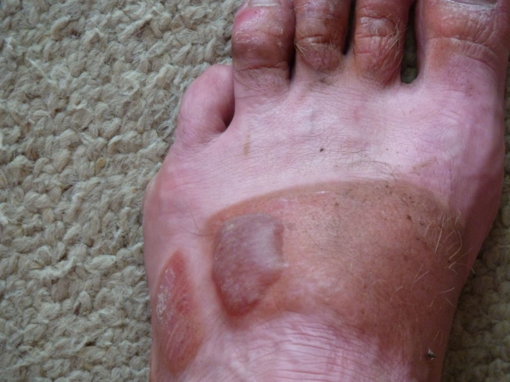 Foot with blister
